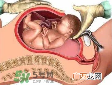 剖腹产比顺产安全吗？剖腹产产后注意事项？