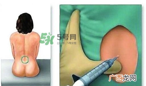 无痛分娩为什么不提倡？无痛分娩有后遗症吗？