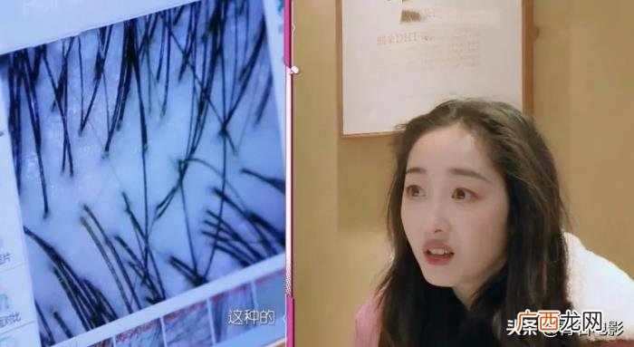 女明星植发，蒋梦婕成第一个敢在镜头前植发的女明星