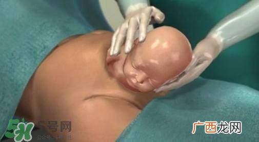 剖腹产的过程 剖腹产的步骤及时间