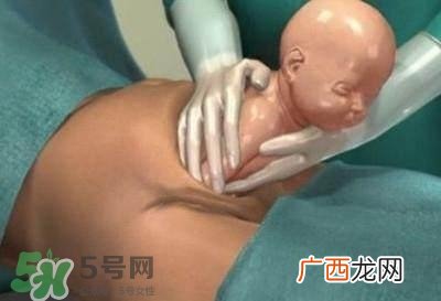 剖腹产的过程 剖腹产的步骤及时间