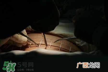 剖腹产的过程 剖腹产的步骤及时间