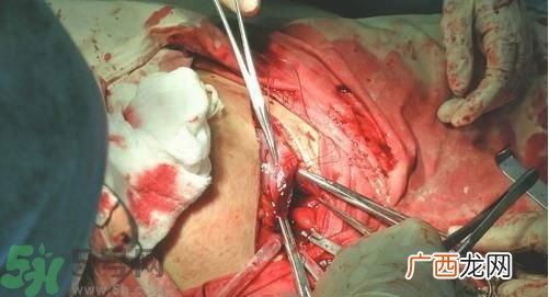 剖腹产伤口多久愈合?剖腹产伤口怎么恢复的快