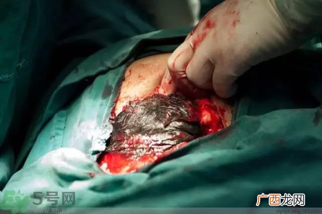 剖腹产伤口多久愈合?剖腹产伤口怎么恢复的快