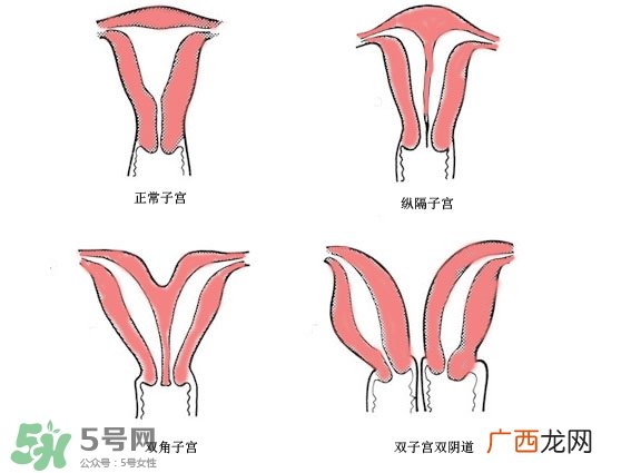 双子宫是什么意思？双子宫可以顺产吗？