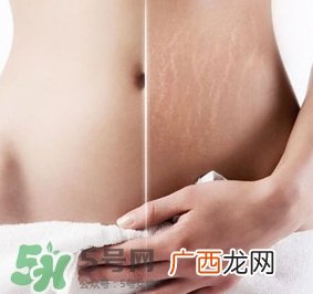 妊娠纹什么时候变白？妊娠纹产品什么时候用？