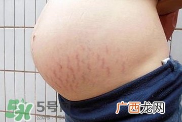 妊娠纹什么时候开始预防?妊娠纹什么时候消除?