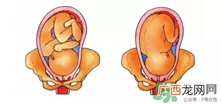 胎位不正能顺产吗？胎位不正怎么办？
