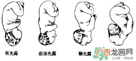 胎位不正能顺产吗？胎位不正怎么办？
