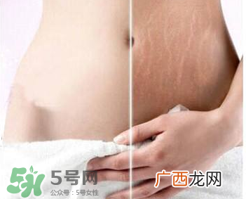 妊娠纹怎么长在大腿上了？妊娠纹会不会长在大腿上？