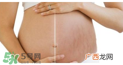 妊娠纹到底是怎么样形成的？妊娠纹形成的原因是什么