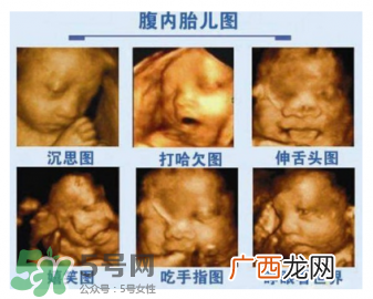 四维彩超有必要做吗？四维彩超检查不出什么？