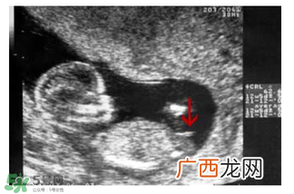NT超图全景看宝宝性别，亲证有效的B超自测男女方法