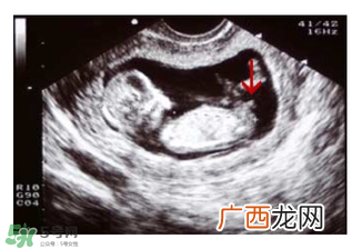 NT超图全景看宝宝性别，亲证有效的B超自测男女方法