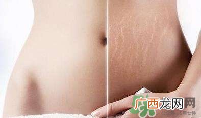 妊娠纹什么时候长出来？哪种皮肤容易长妊娠纹？
