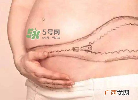 剖腹产疤痕怎么去除？剖腹产疤痕能去掉吗？
