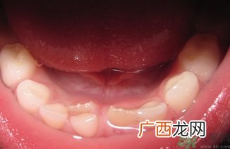 双排牙是什么?双排牙的危害