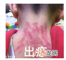 吮痧有什么疗效？最温柔的治病方法