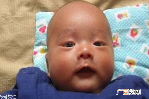 宝宝奶藓会自己好吗 宝宝奶藓怎么办
