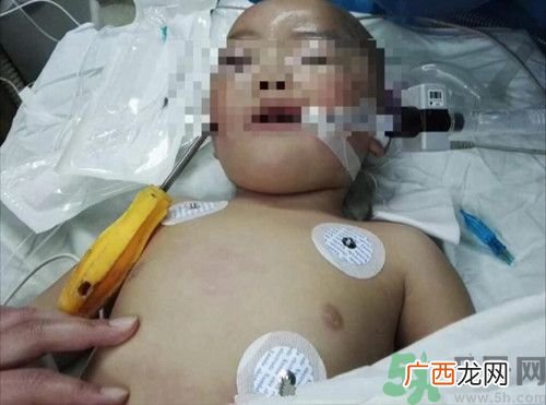 一岁女童玩耍不慎螺丝刀插入脑中 生活中怎样避免孩子受到伤害?