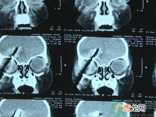 一岁女童玩耍不慎螺丝刀插入脑中 生活中怎样避免孩子受到伤害?