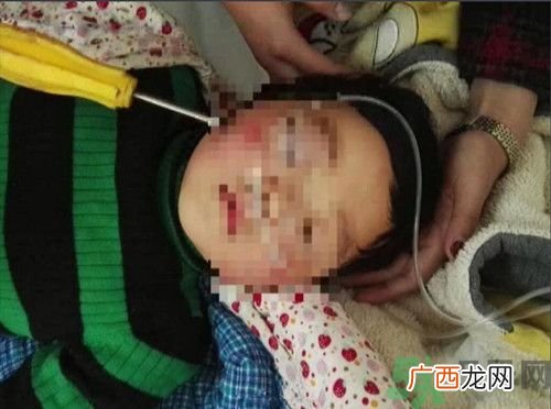一岁女童玩耍不慎螺丝刀插入脑中 生活中怎样避免孩子受到伤害?