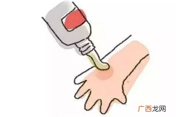 烫伤后的水泡能挑破吗 怎样挑破水泡才不容易引起感染