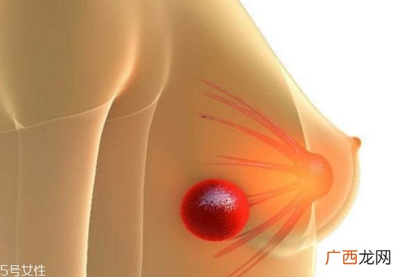 乳腺结节可以消除吗 什么样的乳腺结节属于乳腺癌