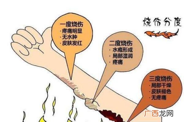 烫伤后起水泡怎么处理 烫伤后起水泡多久能好