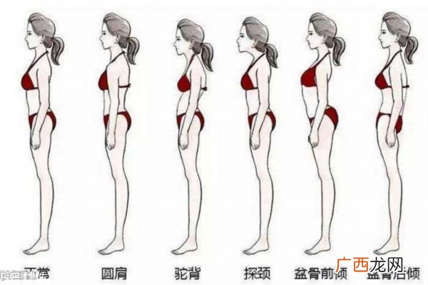 成年后驼背还能矫正吗 驼背易混淆的症状