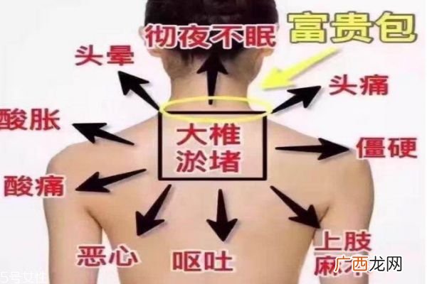 富贵包会引起什么病 教你如何预防