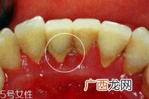 牙结石能自动脱落吗？除了洗牙别无他法