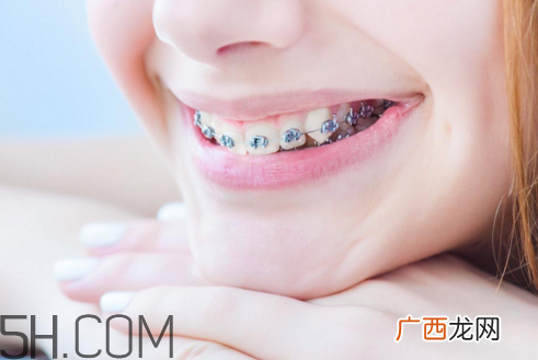 戴牙套的最佳年龄 牙套可以改变脸型吗