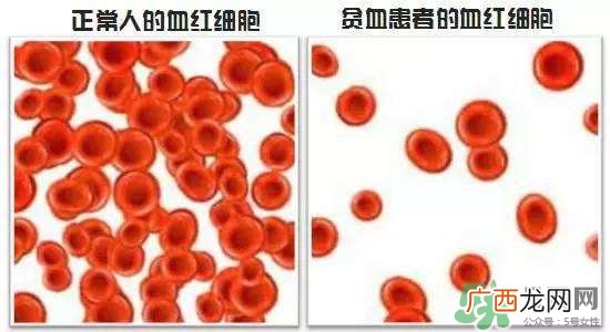缺铁性贫血的症状 缺铁性贫血的症状有哪些？
