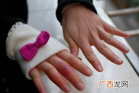 治疗冻疮的中医偏方有哪些 如何预防冻疮