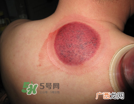 三伏天拔罐后多久可以洗澡？三伏天拔罐后注意事项