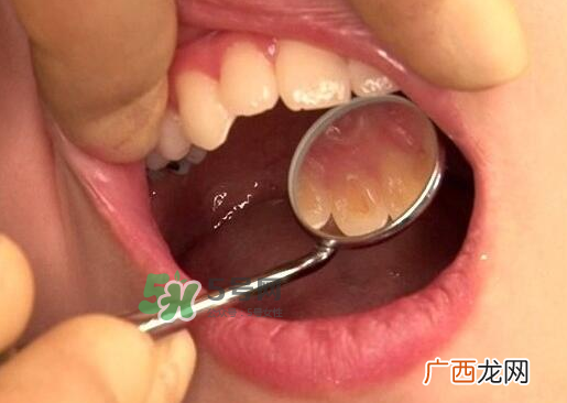 三伏天可以拔牙吗吗?三伏天拔牙好吗？