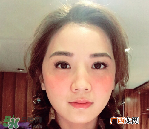 夏天可以点痣吗？夏天点痣后要注意什么？