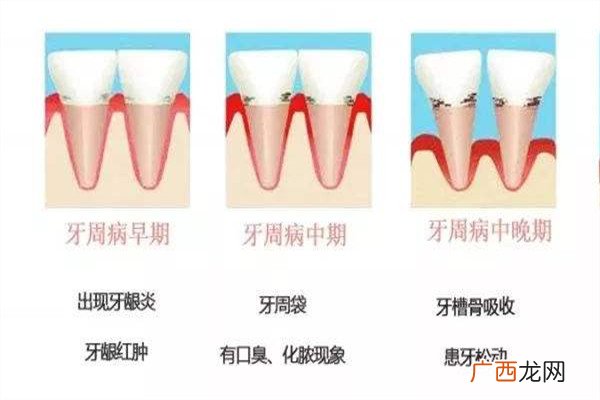 口腔健康的标准是什么 口腔健康管理