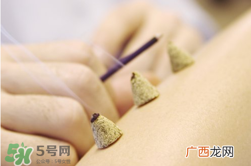 ?三伏灸和艾灸的区别_三伏灸是艾灸吗