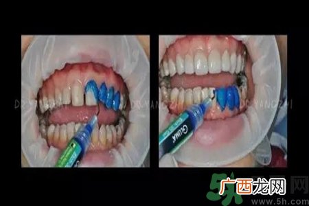四环素牙是什么？四环素牙是怎么形成的？