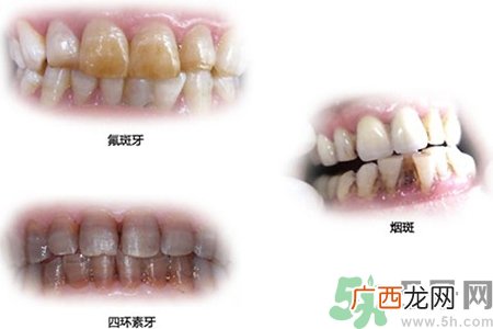 四环素牙是什么？四环素牙是怎么形成的？