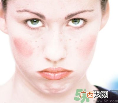 夏季流汗脸痒怎么回事？夏季脸痒怎么办？