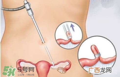 女人怎样避孕最安全？对女人最好的避孕方法