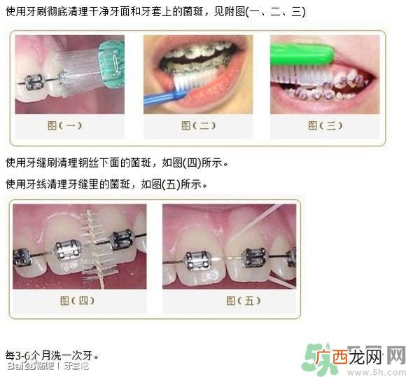 18岁还能戴牙套吗？戴牙套真的能瘦脸改变脸型吗？