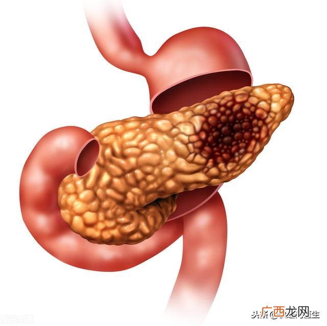 胰腺癌晚期能活多久,创业生存期多久