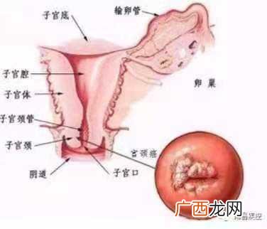 做完宫颈癌筛查来月经了 月经过后多久可以做宫颈筛查