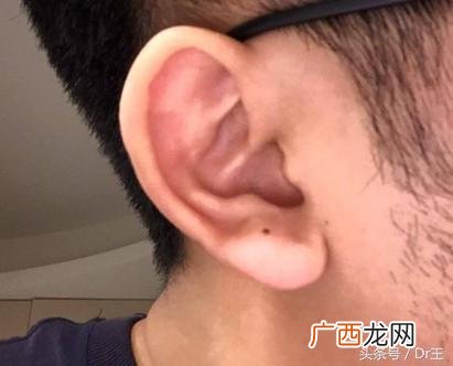 右耳垂有痣代表什么意思 耳垂痣