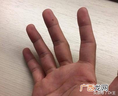 右耳垂有痣代表什么意思 耳垂痣