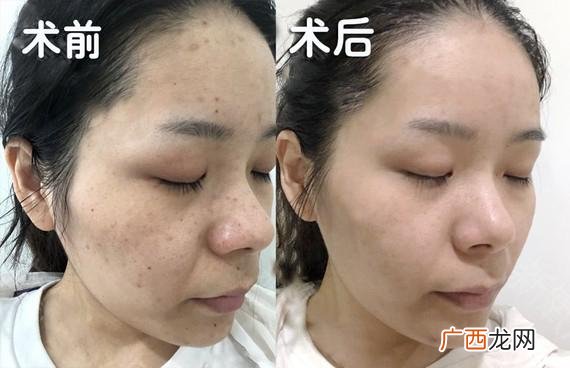 医美祛斑有哪几种 医美祛斑多少钱